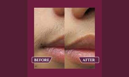 Before And After Results-Layers  Clinics