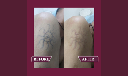Before And After Results-Layers  Clinics